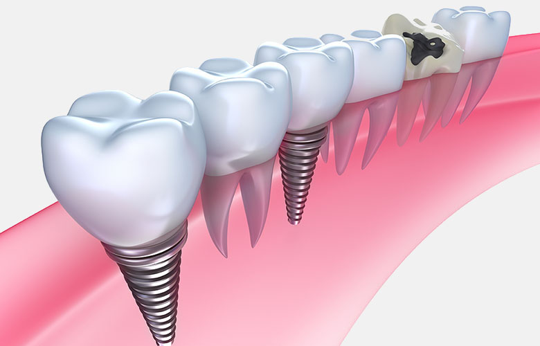Restoration Dentistry Restoration Dentistry
