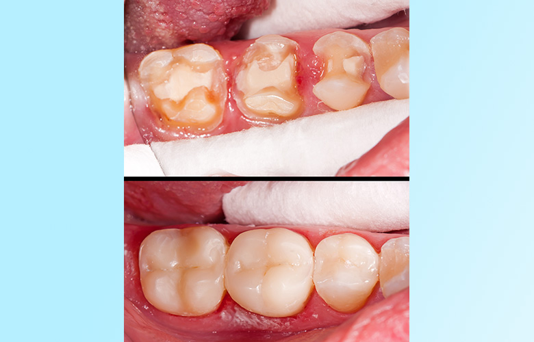 Preventative Dentistry Preventative Dentistry