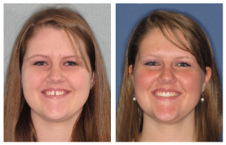 Treatment before after2 Treatment before after2