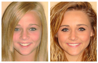 Treatment before after3 Treatment before after3